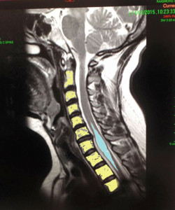 The blue shows the syrinx (or cyst) inside the spinal cord (the yellow is the spine). 